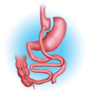 Gastric bypass diagram